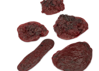 Clots and Hemorrhages - Set of 5 Life/Form®